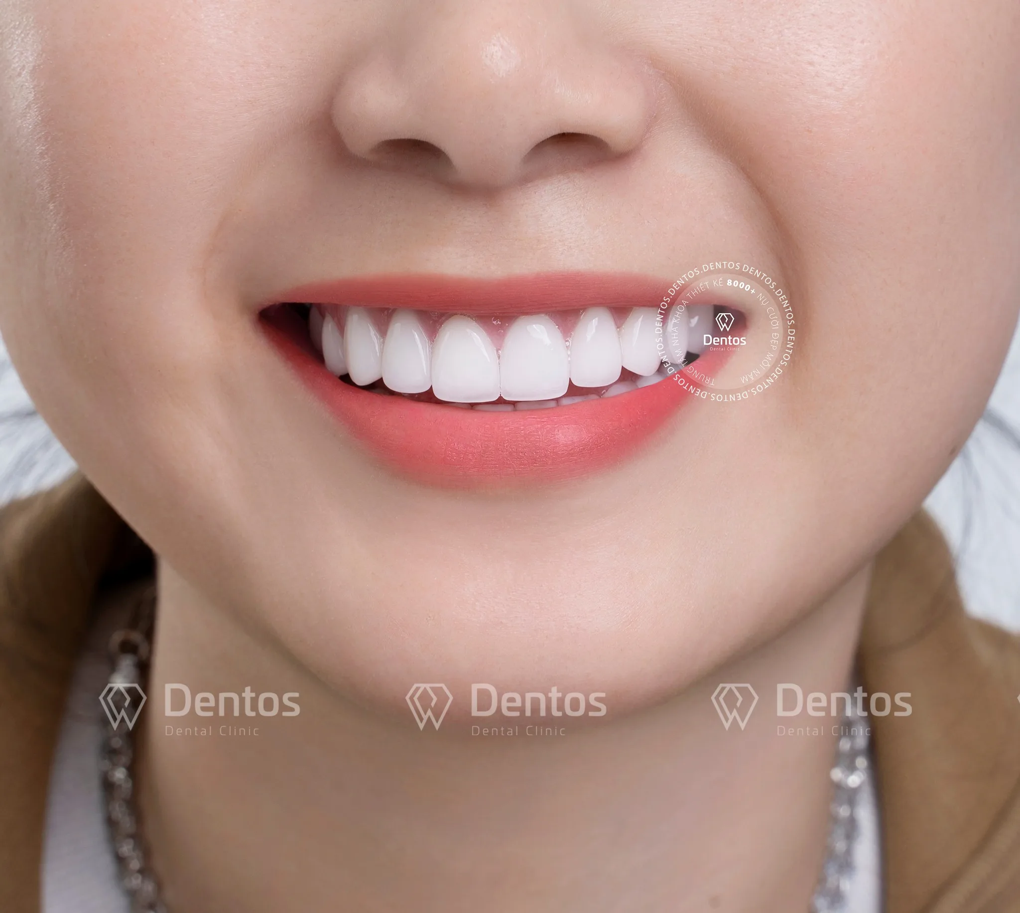 Bọc lại răng sứ mới là giải pháp tối ưu khi răng sứ bị vỡ lớn, ảnh hưởng cấu trúc